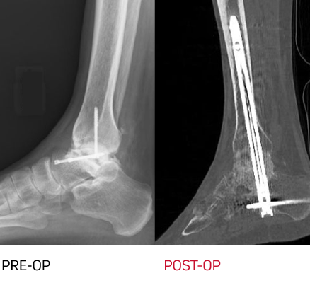 x-ray - large boney defects