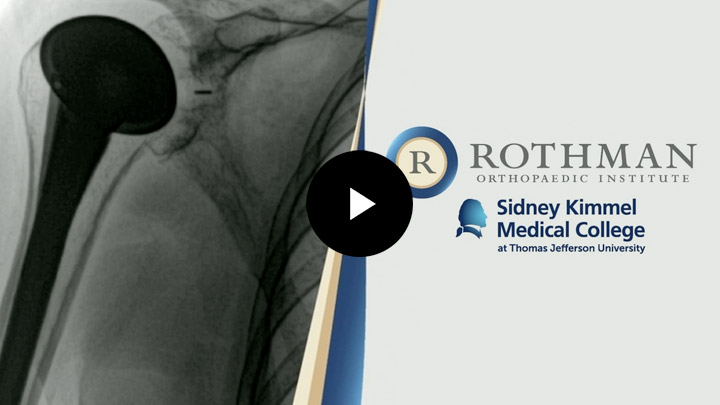 Augmented Glenoid Surgery - Rothman