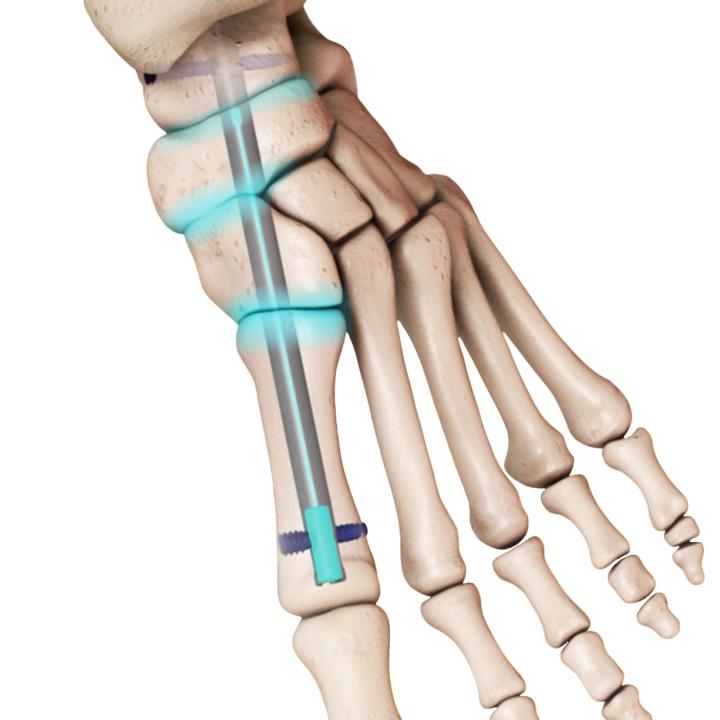 DynaNail Mini® for Medial Column Fusion System - In Bone