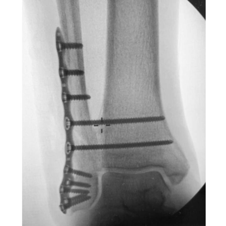 Arsenal Ankle Plating System™ - Ankle x-ray