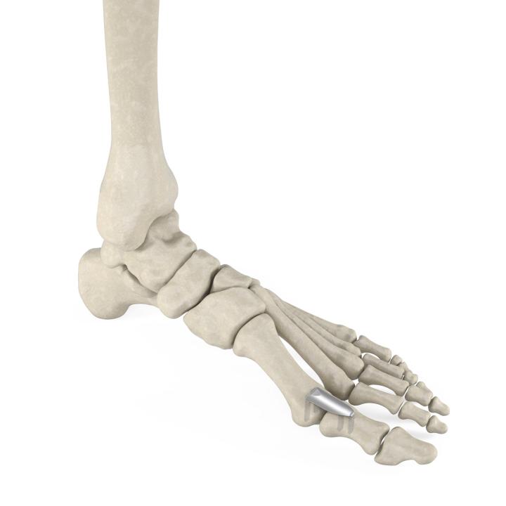 Dynaclip Delta™ - in bone